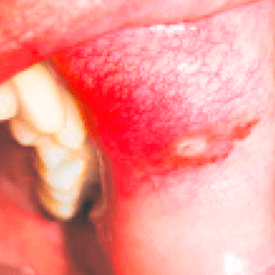 aftowe zapalenie jamy ustnej