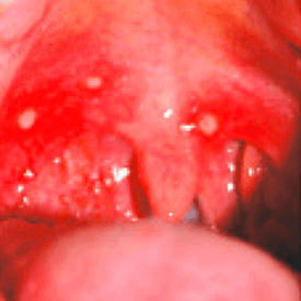 owrzodzenia aftowe w jamie ustnej