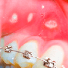 uszkodzenia aftowe spowodowane aparatami ortodontycznymi lub źle dopasowanymi protezami