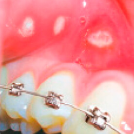 Inne uszkodzenia błony śluzowej jamy ustnej