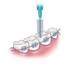 Jak czyścić stały aparat ortodontyczny i uzupełnienia protetyczne?
